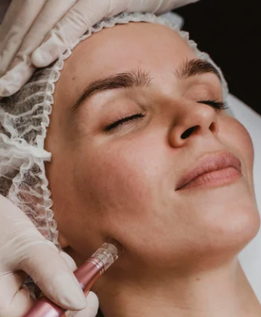 Microagulhamento - clinica de estética em Curitiba